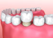 teeth after home flouride treatments