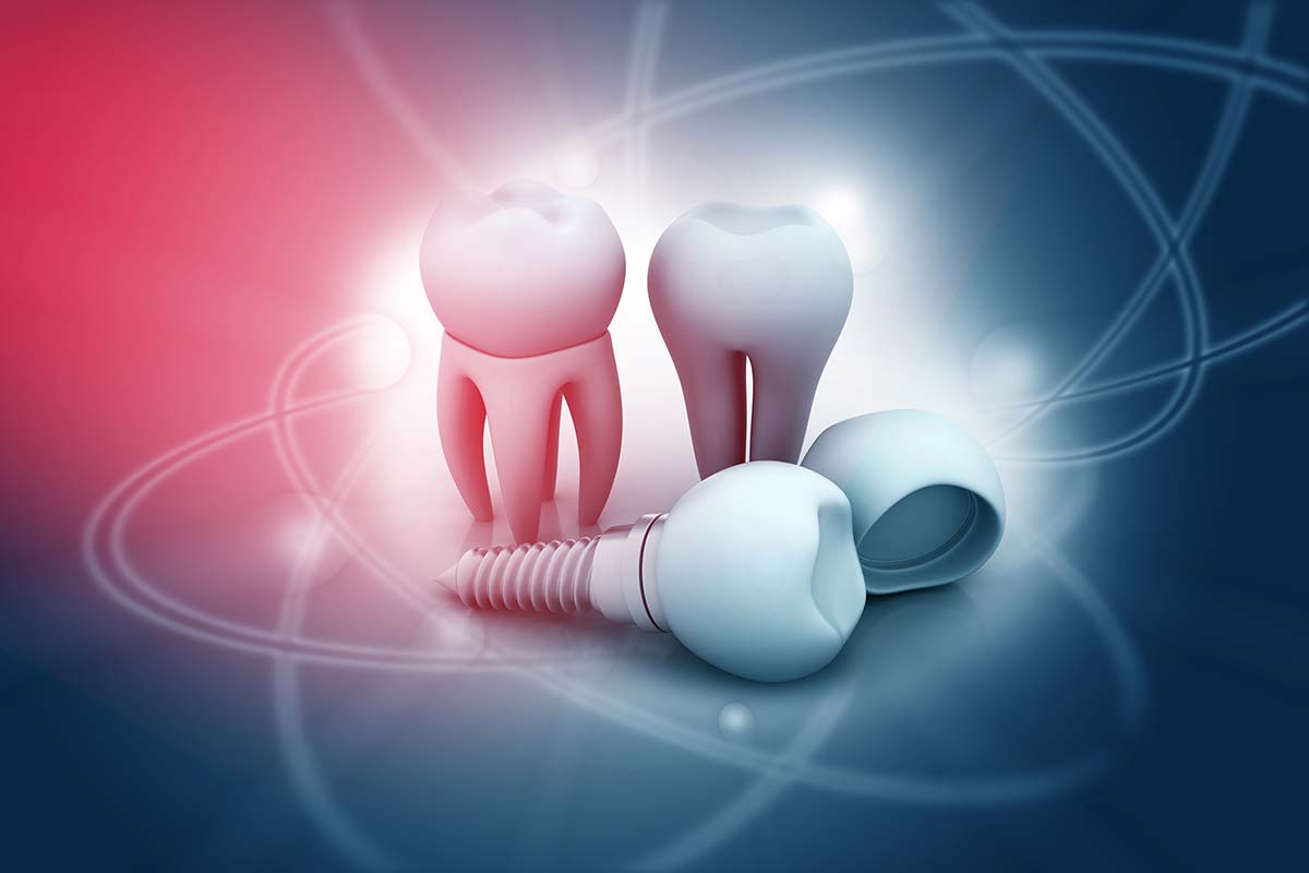 What Are Dental Implants (1) dental implants can help improve your smile