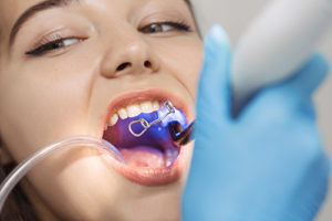 teen girl receiving dental bonding in jersey village tx