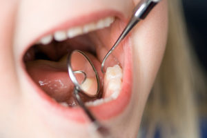 child getting dental fillings and sealants in jersey village tx