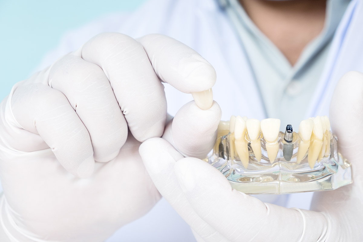 dentist showing a model of a dental implant