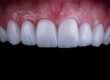 a sample of teeth represents the benefits of dental veneers