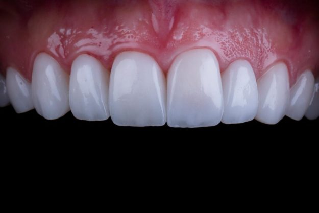 a sample of teeth represents the benefits of dental veneers