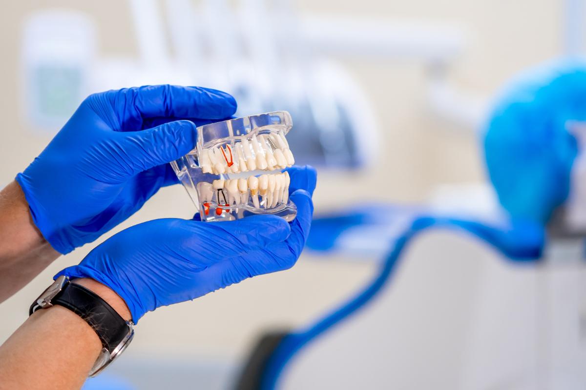 a sample of teeth show a sample of dental implants